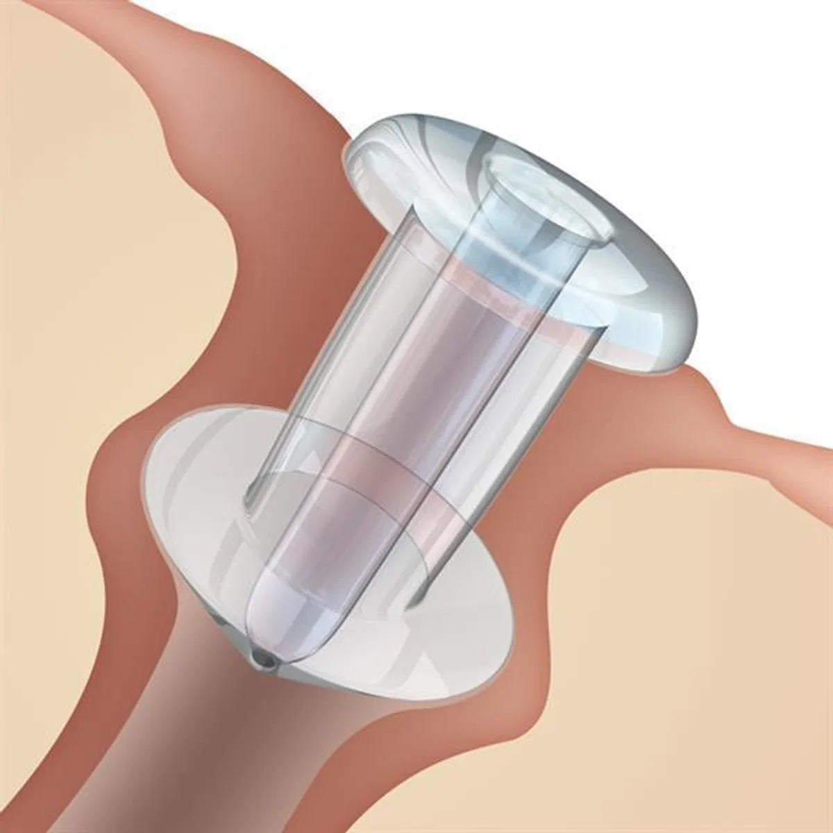 SOFT PLUG® Silicone Flow Control, Preloaded 2 Pack