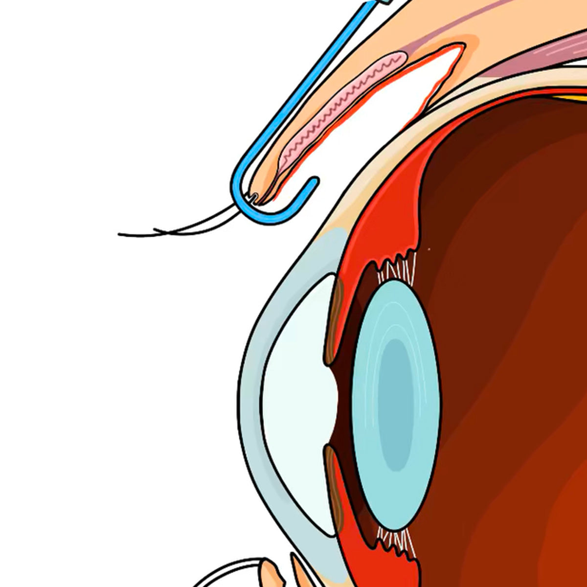 Rinsada - Irrigating Eyelid Retractor (1 Rinsada + 2 Saline Syringes)