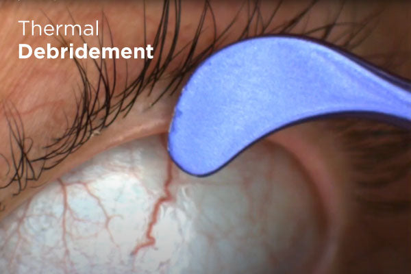 Close-up of a medical procedure showing a blue tool performing thermal debridement on an eyelid. The eye is open, with visible eyelashes and blood vessels on the white of the eye. Text reads Thermal Debridement.