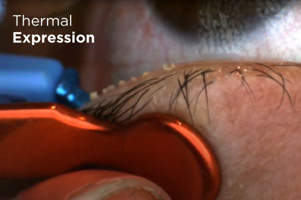 Close-up of a persons eyelid with a thermal expression device applied near the eyelashes. The device appears to be a small tool with a blue and orange section, gently lifting the lashes. The text reads Thermal Expression.