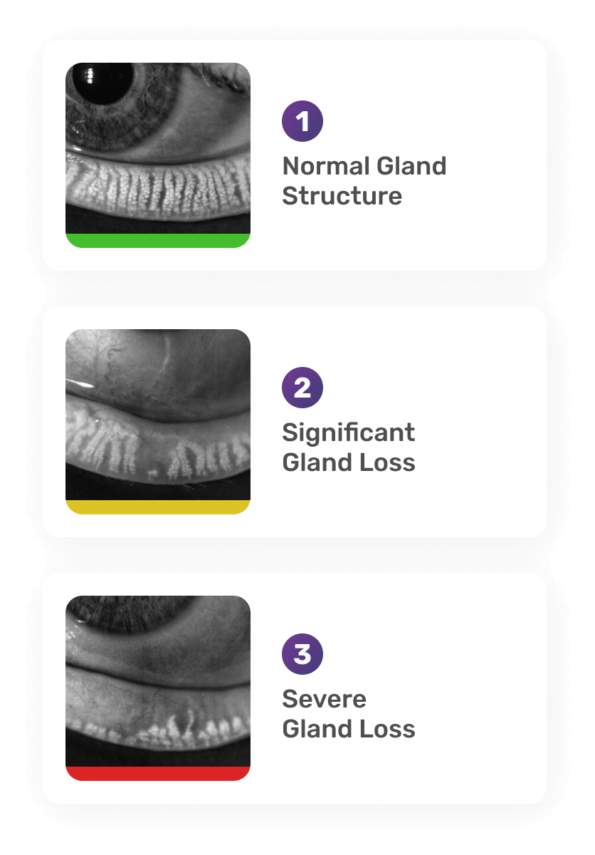 Three images of eyelid glands. 1: Normal gland structure with a green bar, labeled Normal Gland Structure. 2: Significant gland loss with a yellow bar, labeled Significant Gland Loss. 3: Severe gland loss with a red bar, labeled Severe Gland Loss.