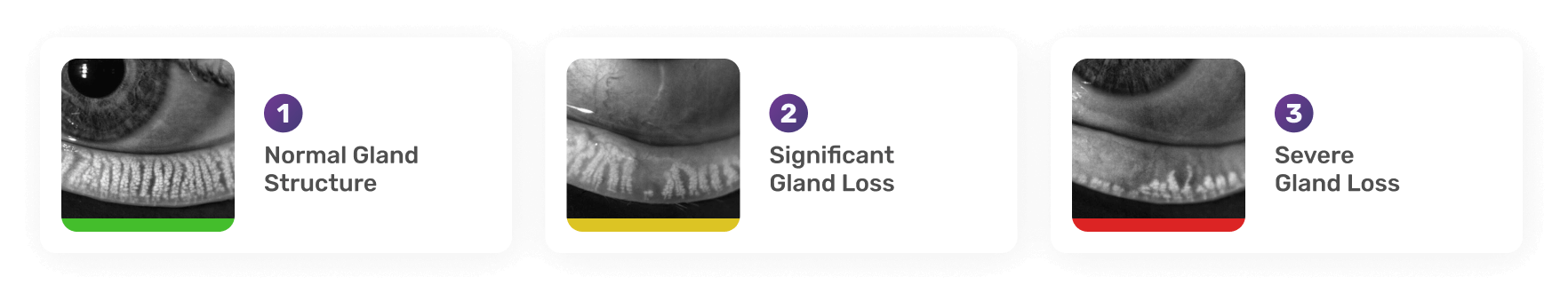Three labeled images of eyelid gland structures: 1) Normal Gland Structure with a green border, 2) Significant Gland Loss with a yellow border, 3) Severe Gland Loss with a red border.