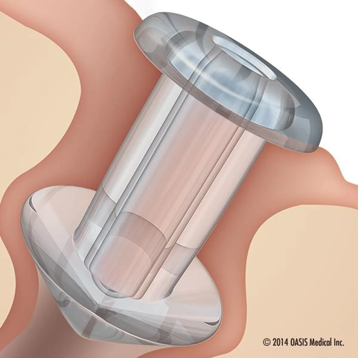 SOFT PLUG® Silicone Punctum Plug