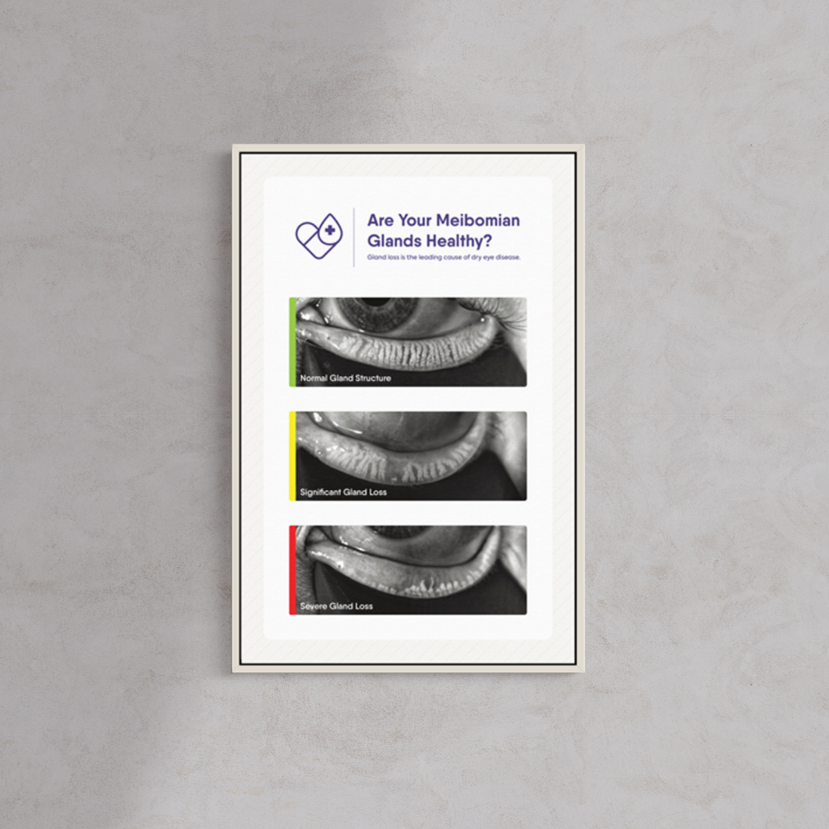 A framed DryEye Rescue poster on a gray wall displays eyelids titled Normal Gland Structure, Significant Gland Loss, and Severe Gland Loss. Titled Are Your Meibomian Glands Healthy?, it promotes dry eye awareness, encouraging viewers to explore the Awareness and Compliance Booster Package.