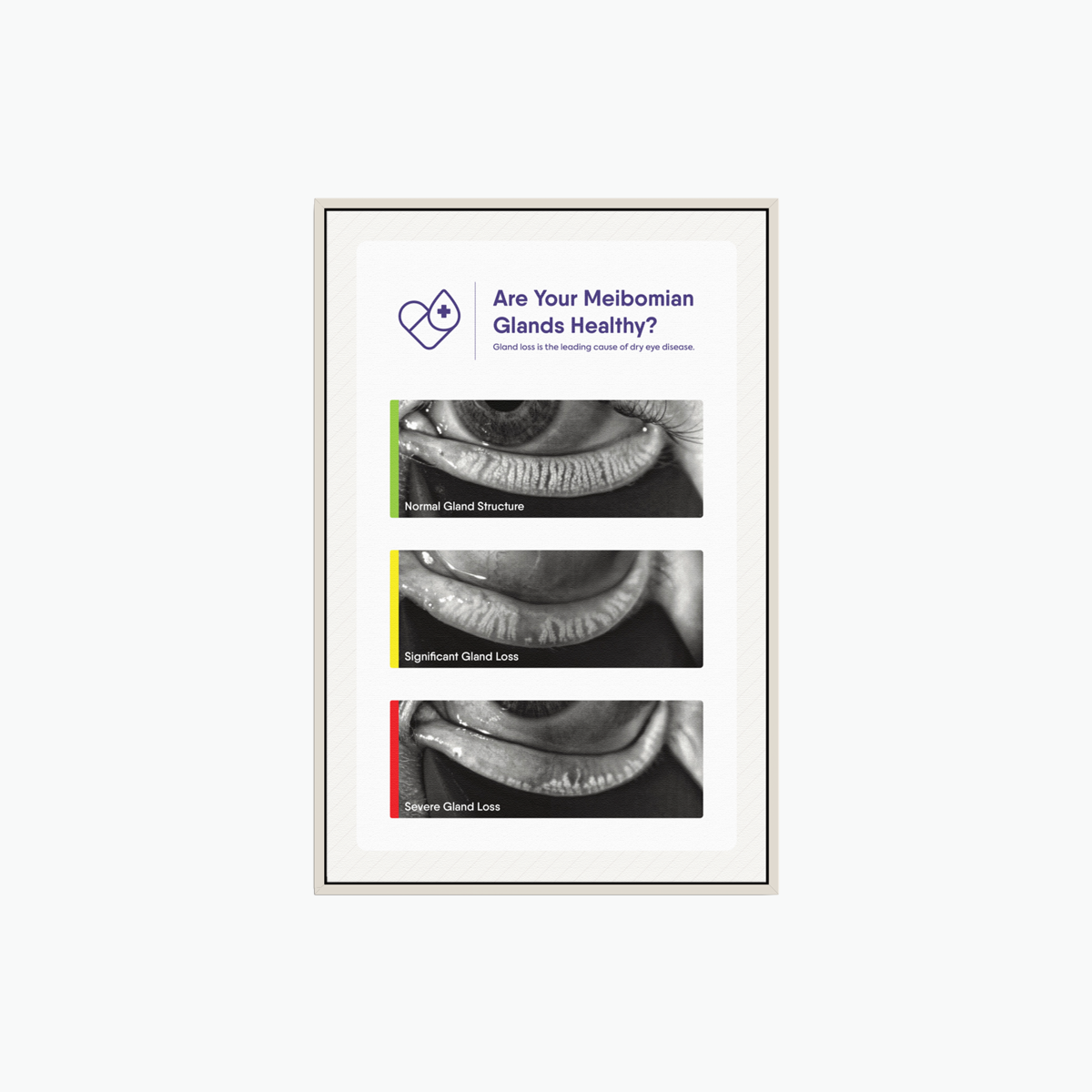 The Framed Canvas Meibomian Gland Grading Scale by DryEye Rescue features three grayscale diagrams of an eyes meibomian glands, captioned Normal Gland Structure, Significant Gland Loss, and Severe Gland Loss. A heading questions if your glands are healthy. Available in 3 frame colors.