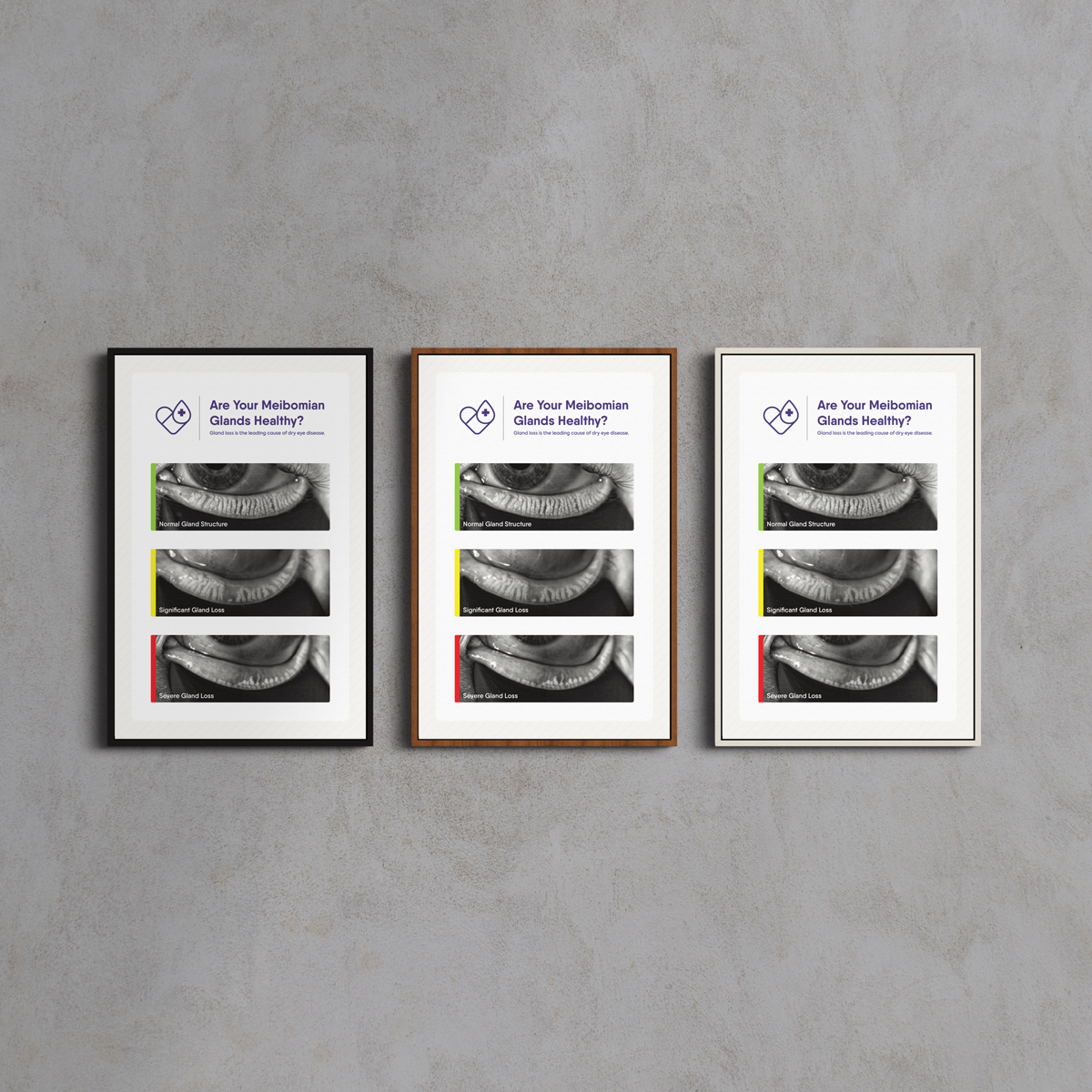 Three Framed Canvas Meibomian Gland Grading Scale posters by DryEye Rescue hang on a gray wall, each showing a close-up of an eye with color-coded sections—green, yellow, and red—depicting different health states of meibomian glands.