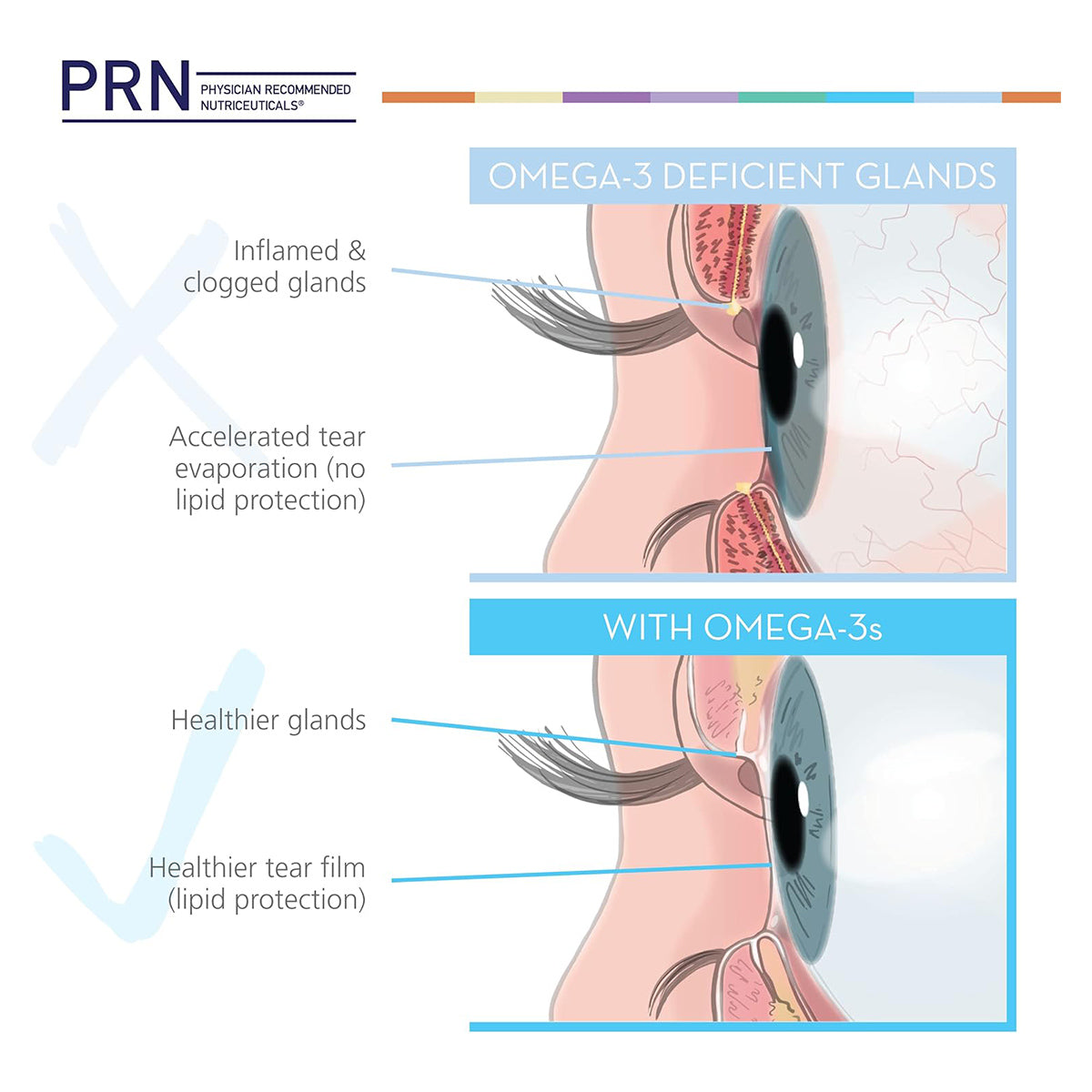 An illustration depicts two scenarios: the top shows inflamed, clogged glands with accelerated tear evaporation from omega-3 deficiency; the bottom illustrates healthier glands and tear protection using PRN Eye Omega Benefits for Kids, rich in EPA and DHA omega-3s.