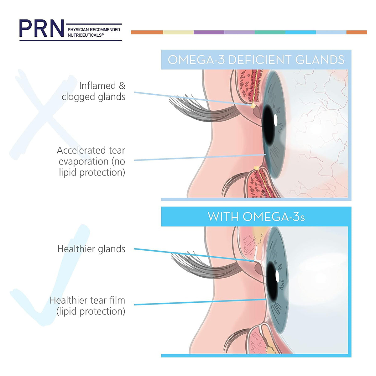 Comparison of omega-3 deficient and supplemented eyes: The top image displays inflamed, clogged glands linked to DE3 Dry Eye, while the bottom highlights healthier glands with PRN DE3 Dry Eye Omega Benefits® from PRN - Physician Recommended Nutriceuticals.