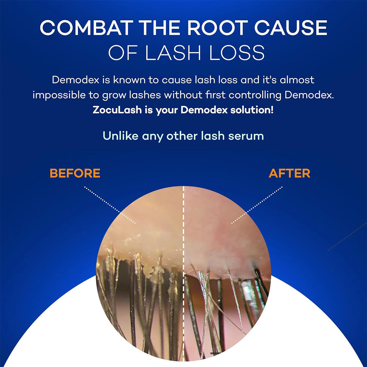 Promotional image for ZocuLash Eyelash Enhancing Serum (2.5mL) by Zocular: Address lash loss at its root with sensitive eyes in mind. Demodex impacts lash health; ZocuLash is your solution! Noticeable improvement in before and after photos.