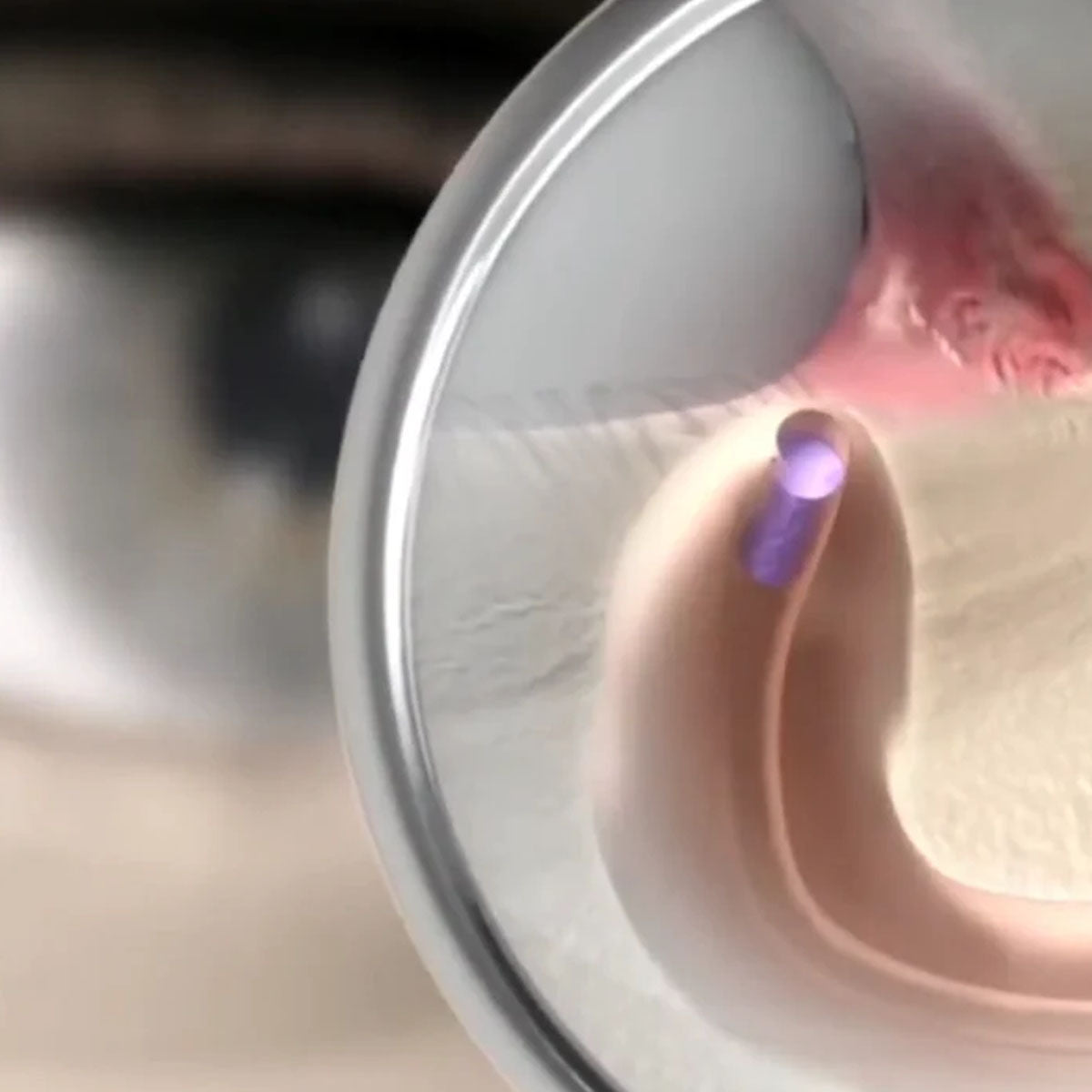 DuraPlug™ Synthetic Extended Temporary Canalicular Plug up to 180 days – (4 Sizes)