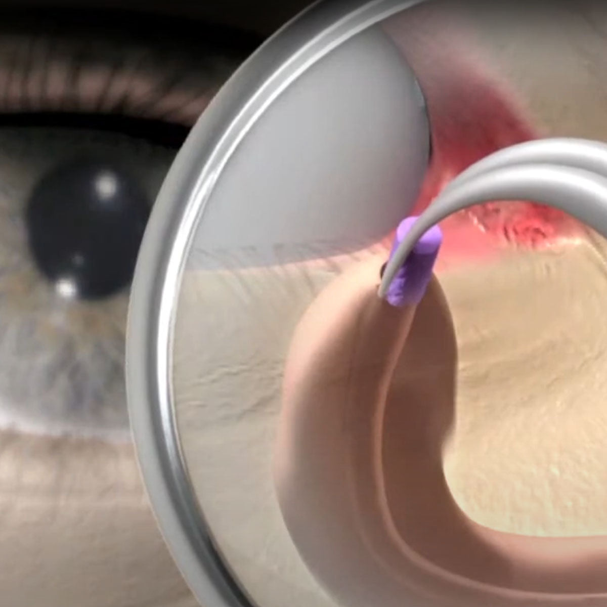 DuraPlug™ Synthetic Extended Temporary Canalicular Plug up to 180 days – (4 Sizes)