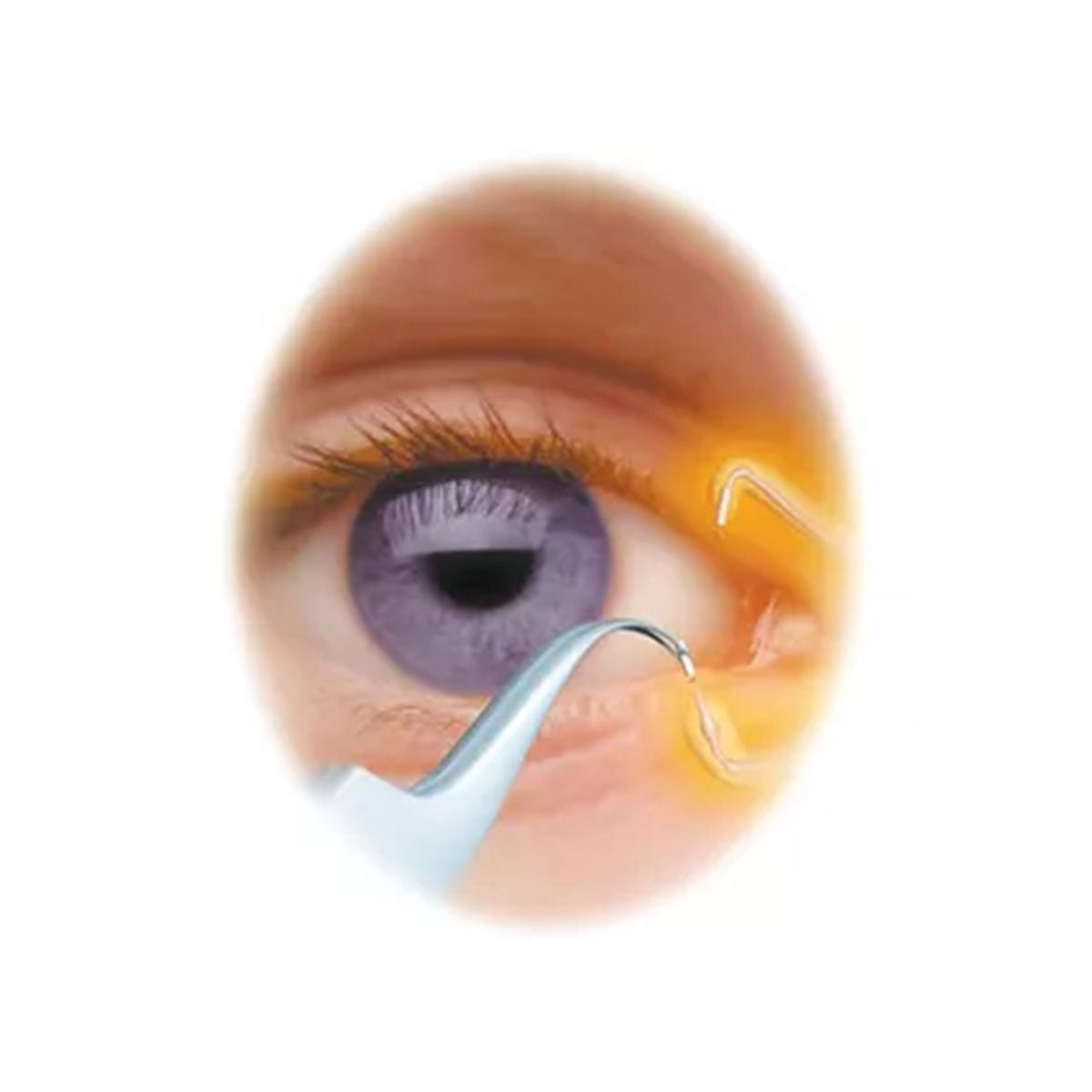 Eagle Vision Collagen Dissolvable Punctal Inserts 2 weeks (60 Inserts)