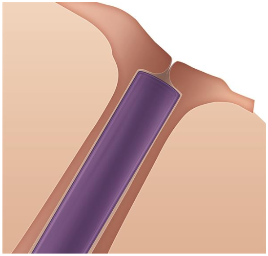 A cross-section illustration shows an ear with an Oasis Medical SOFT PLUG Extended Duration 180 Day Canalicular Plug inserted. The purple plug fully occupies the canal, made from absorbable synthetic materials. Surrounding ear structures are illustrated in soothing beige and light brown shades.