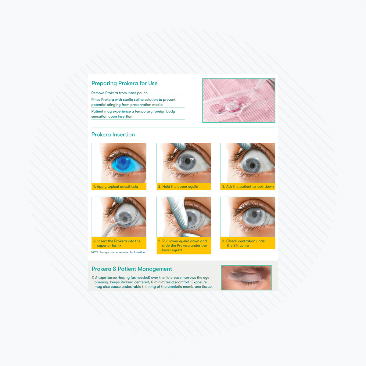 A detailed image depicts instructions for using BioTissues Prokera Amniotic Membranes, covering anesthesia application, eyelid holding, and device insertion. It also illustrates post-insertion care and the regenerative healing process with eye images.
