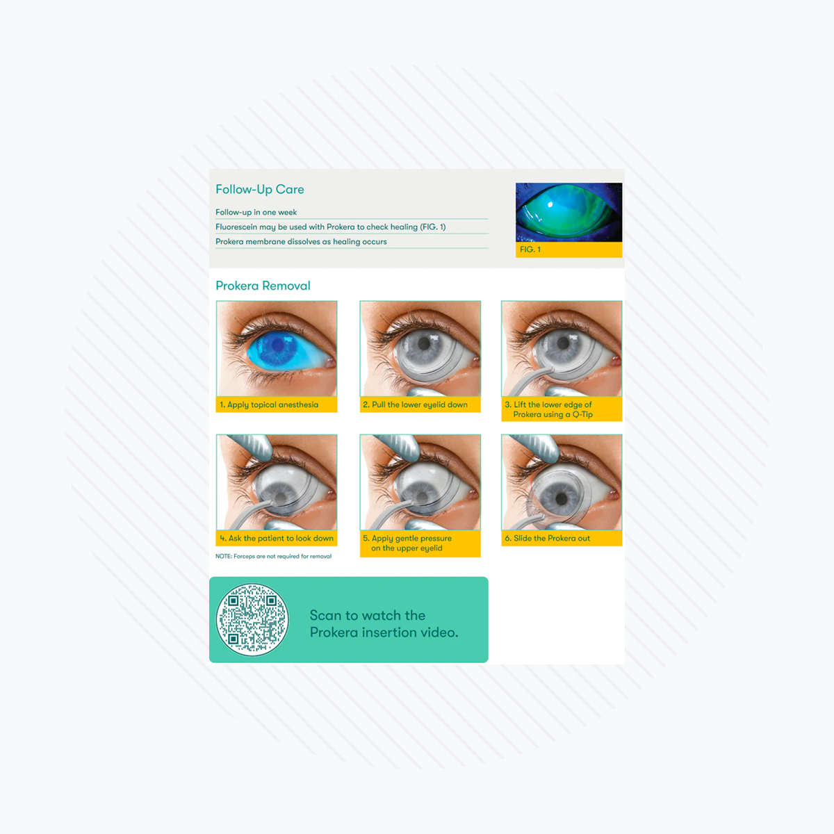 The instructional guide Follow-Up Care for removing BioTissues Prokera Amniotic Membranes outlines six steps with photos: apply ointment, pull the lower eyelid, lift the device, use forceps, pull down, and slide out. It includes a QR code linking to an insertion video and promotes regenerative healing using corneal bandages.
