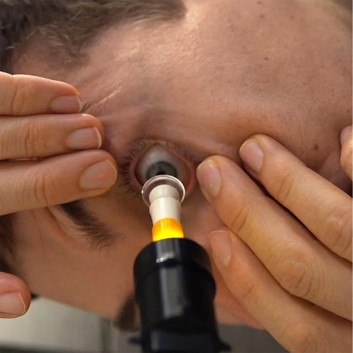 S5 Mini Inserter for Scleral & Hybrid Lens Insertion - With Free Video Training Included