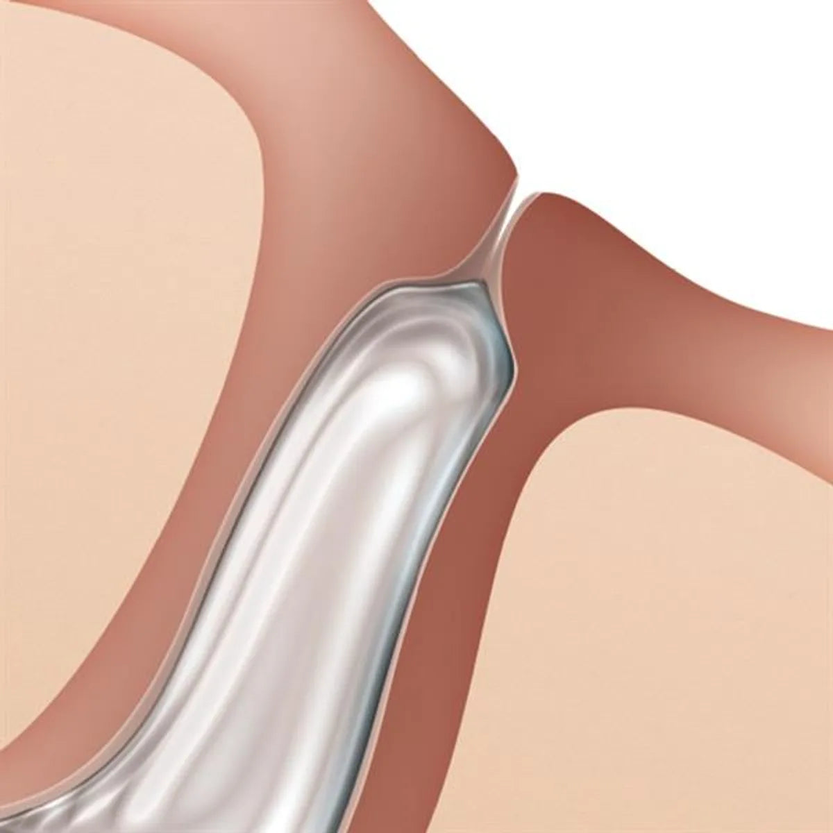 FORM FIT Hydrogel Canalicular Plugs - One Size 0.3mm