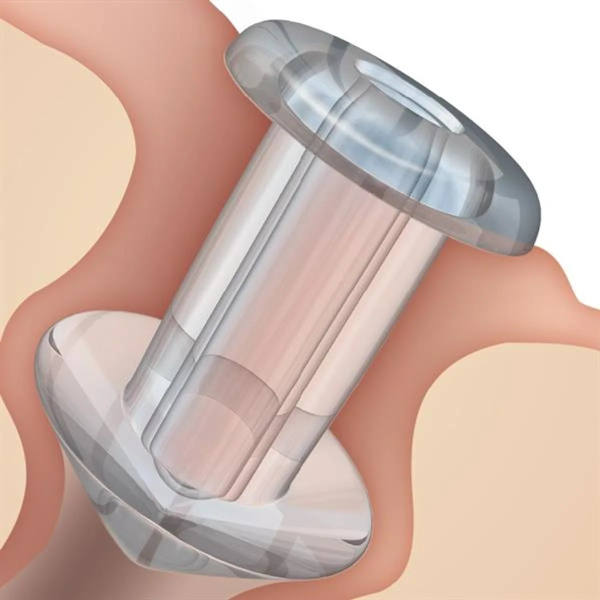 SOFT PLUG® Silicone Punctum Plug