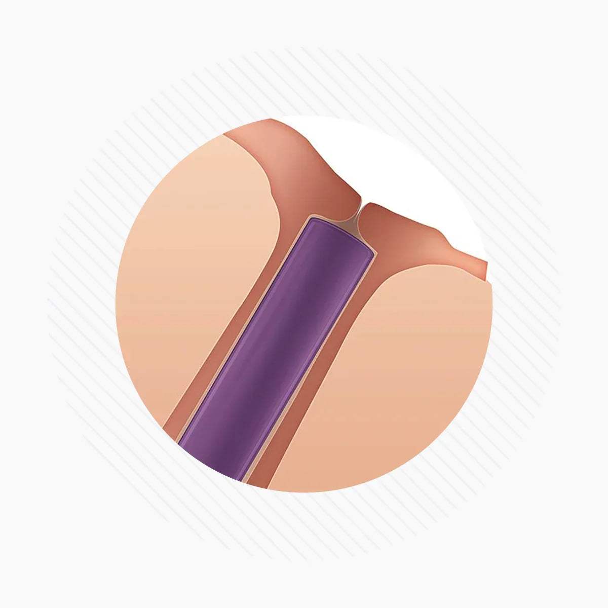Oasis SOFT PLUG Extended Duration 180 Day Canalicular Plugs