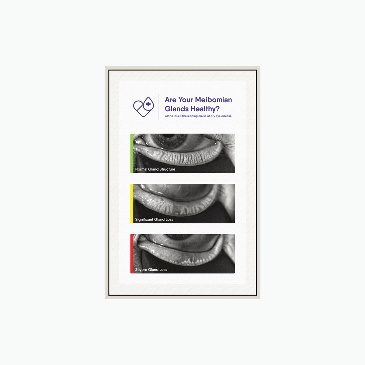 Framed Canvas Meibomian Gland Grading Scale (3 Frame Colors)