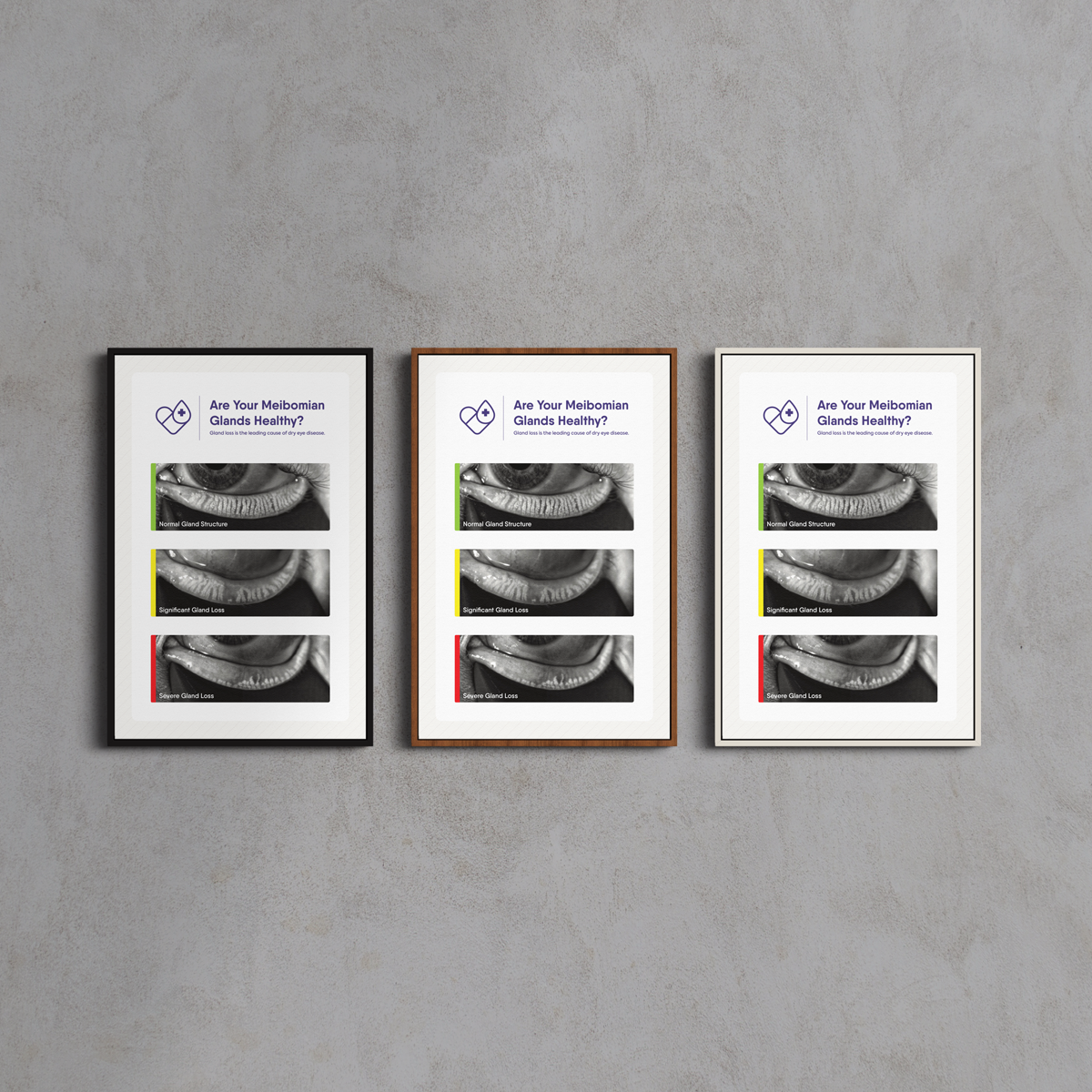Framed Canvas Meibomian Gland Grading Scale (3 Frame Colors)