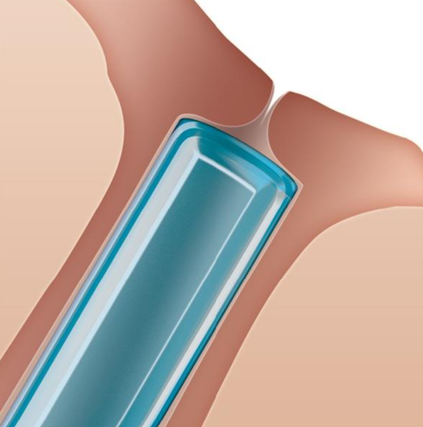 Illustration of the Oasis Medical Extended Duration 90 Day Absorbable Plug, a blue, cylindrical device implanted in a shoulder between bone and muscle structures. Resembling an advanced tear drainage system, it features a shiny, smooth surface.