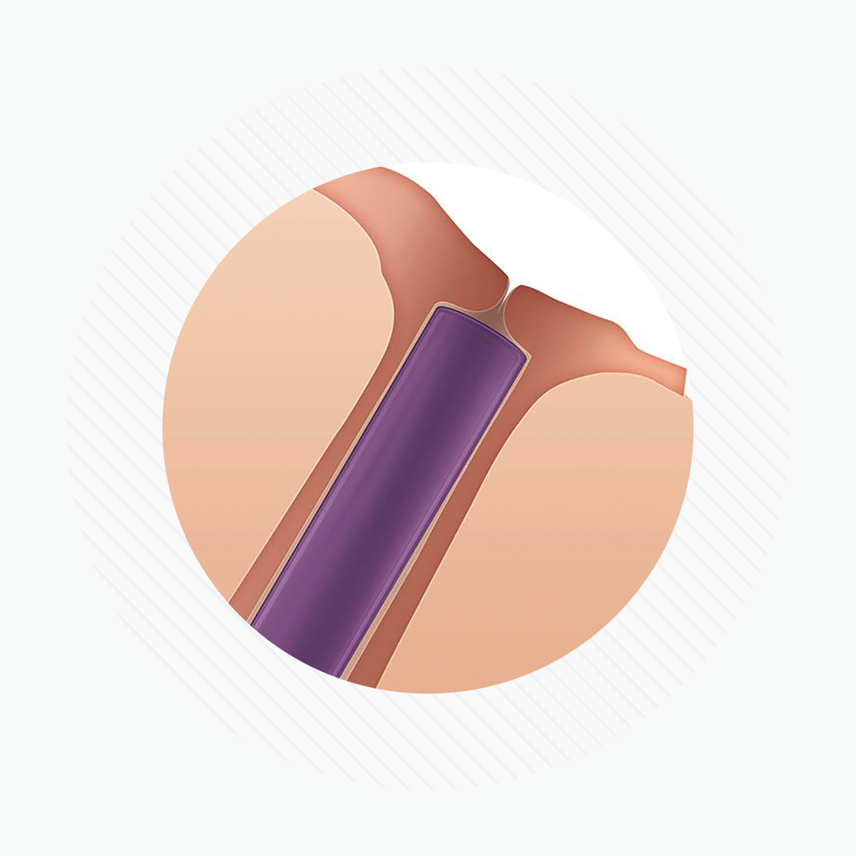 The illustration depicts a medical implant resembling a purple rod placed horizontally under the skin, akin to Oasis Medicals SOFT PLUG Extended Duration 180 Day Canalicular Plugs. The background features a circular design with subtle diagonal lines.