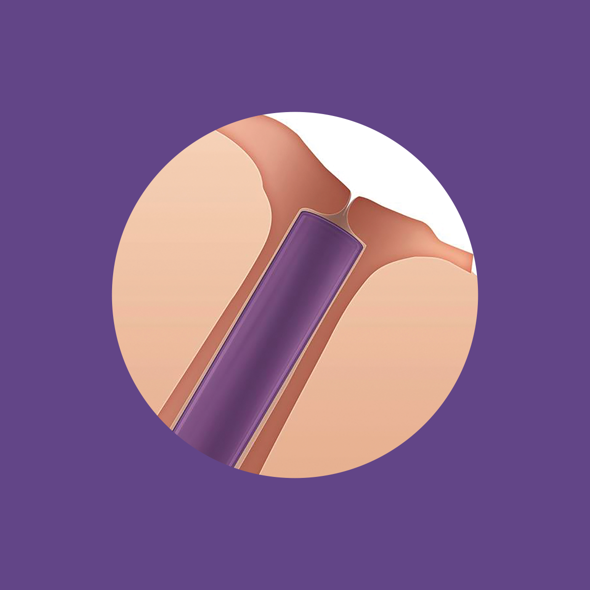 Illustration showing the SOFT PLUG Extended Duration 180 Day Canalicular Plugs by Oasis Medical, inserted under the skin. The small rod is reminiscent of absorbable punctal plugs, set against a purple background.